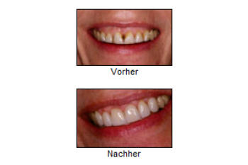 Problem 4 „Zuviel“ sichtbares oder ungleichmässiges Zahnfleisch 