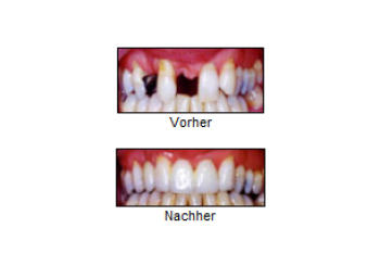 Problem 3: Zahnlücken und fehlende Zähne